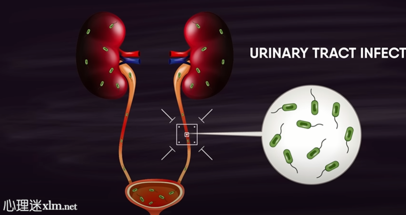 尿路感染的11个潜在原因